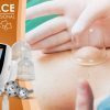 Masážní přístroj na vakuovou drenáž BeautyRelax Vacuform Professional