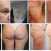 Masážní přístroj na celulitidu BeautyRelax Rollskin BodyShape Madero Professional Quattro