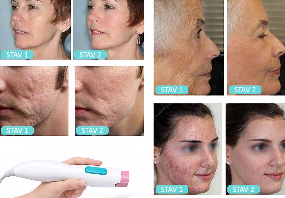 Estetický přístroj pro lifting pleti BeautyRelax Fraxlift Studio Performance