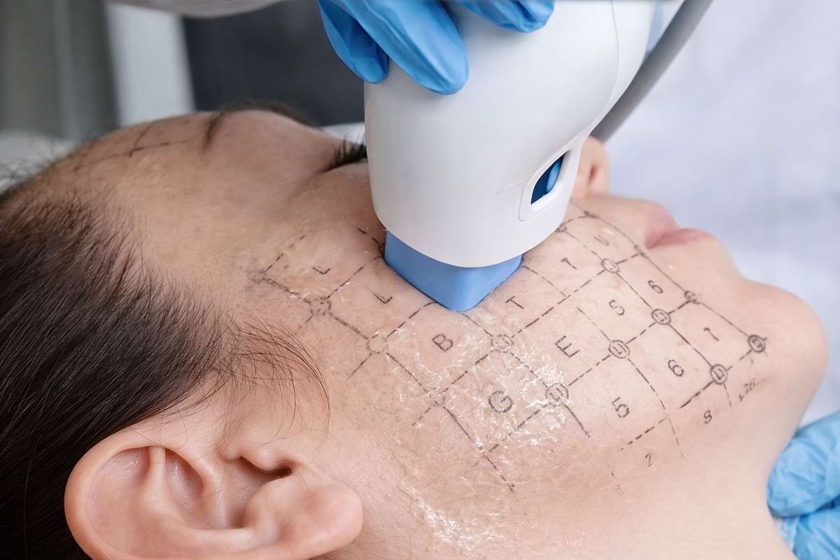 Estetický přístroj pro lifting pleti BeautyRelax Fraxlift Studio Performance